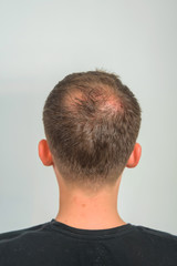 The guy in the medical office. Male pattern baldness. Mesotherapy of the scalp. Bald on the man's...