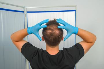 Guy in blue latex holding his head. Male pattern baldness. Mesotherapy of the scalp. Bald on the...