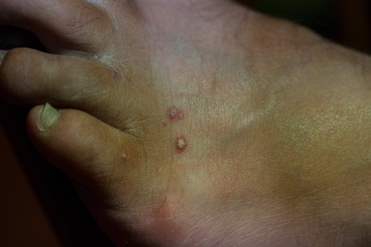 Fire Ant Bite Marks