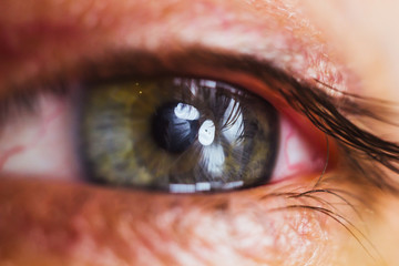 open human eye with bright red arteries close up. irritation and redness of the eyeball. pupils,...