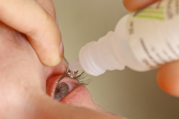 a man drips open human eye with bright red arteries drops to improve vision close up. irritation...