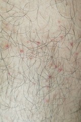 rash of prickly heat on leg skin of asian man