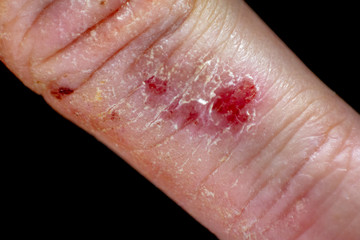 Fototapeta premium Hand dermatitis eczema on black background. 
