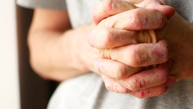 The man scratches his hands. Very itchy fingers, psoriasis.