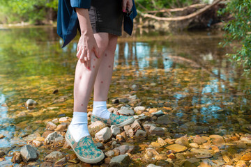 Young woman scratching her leg due to insect bite in nature. Leg covered in a rash. In the...