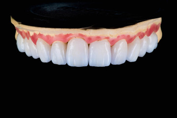 dental veneers and crowns