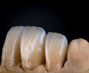 dental veneers and crowns