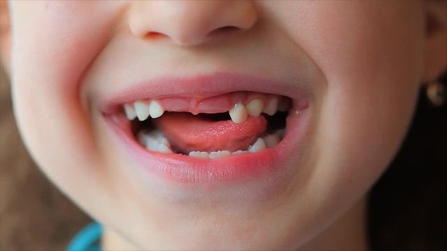 Close-up of a Little Girl's smile, Baby Teeth. Child Shakes His Tongue Milk Tooth.