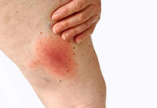 Wanderröte durch eine Zecke übertragene Lyme-Borreliose Erkrankung am Bein einer Frau. Borreliose Erkrankung durch einen Zeckenbiss am Oberschenkel