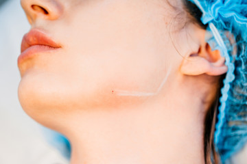 Non-surgical mandibloplasty - the corners of the mandible - Painless and safe intradermal injections are effective for correcting mimic and senile wrinkles, including nasolabial triangle folds