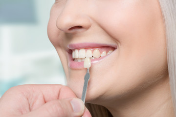 Close up of dentist using shade guide at woman's mouth to check veneer of teeth for bleaching