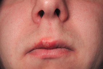 Fototapeta premium Second day of growing herpes on caucasian male man on front upper lip