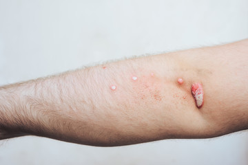 Close-up of irritation, rash on the skin of the human hand.