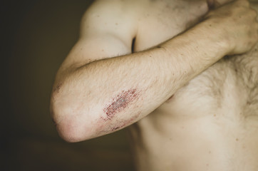 The young man was injured in sports.