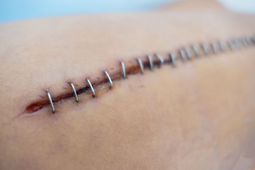 wound sutures in  body of patients in the hospital. Wound sewn with steel wire .