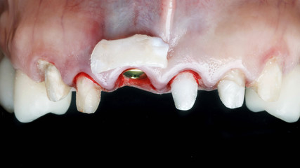 soft tissue on the gum for the mucosal volume