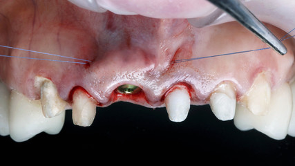 soft tissue closure after front tooth implantation