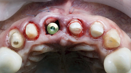 suturing and adding soft tissue after implantation