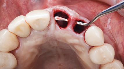extracted two teeth before implantation and shows the volume of the gums