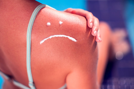 Woman with sun protection cream on her burned skin in the shape of sad smile. Summer, healthcare and vacation concept