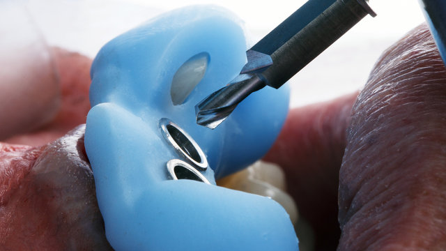 special cutter for surgical template during tooth implantation