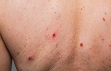 Fototapeta premium Many birthmarks on the girl's back. Medical health photo. Woman's oily skin with problems acne.