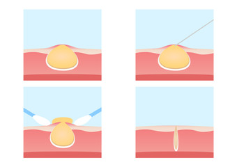 Acne and Pimples remove vector