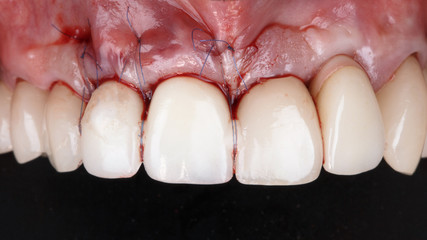 stitched and taut gums with crowns of the front teeth after implantation