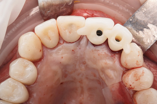 established dental crowns after implantation, photograph through the dental mirror