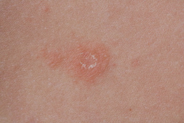 Pityriasis rosea three weeks after the appearance of the first focus on the skin of a young woman....