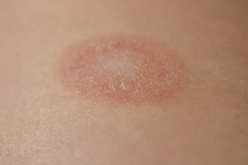 Fototapeta premium Pityriasis Rosea is a type of dermatitis with a mild pink or red skin rash and a flaky rash, maternal plaque, the first biggest papula. Gibera Syndrome.