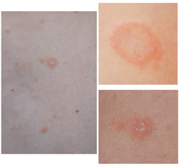 Collage of Pityriasis Rosea rash. Left side is rush on the back, top right is maternal plaque, bottom right is rash three weeks after the appearance of the first focus. Gibera Syndrome.