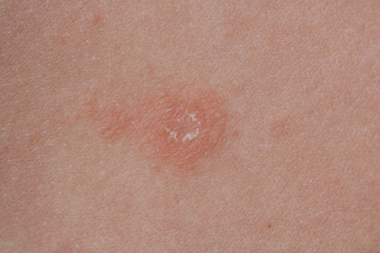 Pityriasis rosea three weeks after the appearance of the first focus on the skin of a young woman. A pink lichen is an approximation on the back. Gibera Syndrome.