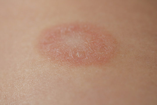 Pityriasis Rosea is a type of dermatitis with a mild pink or red skin rash and a flaky rash, maternal plaque, the first biggest papula. Gibera Syndrome.