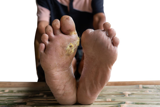 Diabetic foot, with the left foot cut to prevent the spread of infection, the right foot is the inflammation of the wound is infected, On white isolated background to health and diabetes concetp.