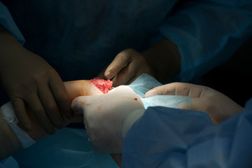 Hand Fracture With Bare Bone