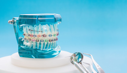 orthodontic model and dentist tool - demonstration teeth model of varities of orthodontic bracket or brace - obrazy, fototapety, plakaty