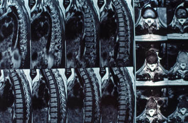Magnetic resonance imaging of the human spine. Hernia on the spine. Selective focus.