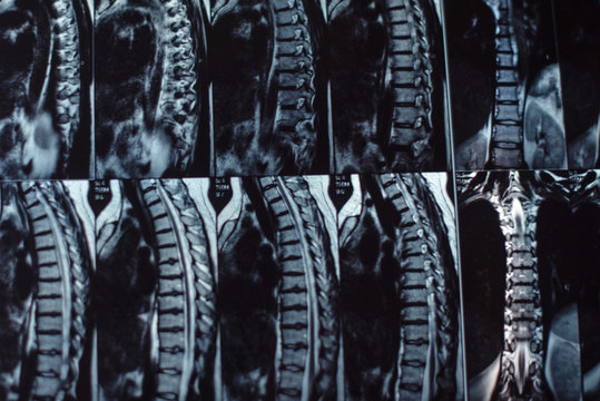 Magnetic resonance imaging of the human spine. Hernia on the spine. Selective focus.