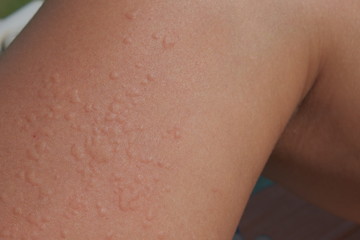 Close up image of symptoms of itchy urticaria , Rash Background.