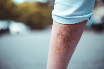 Young person wearing white shorts with a bruised leg with a grey blurred background – Small and painful injury caused by minor accidents