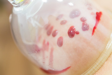 Hijama - the treatment of bloodletting. Attached vacuum cup. Blood fills in the cup.