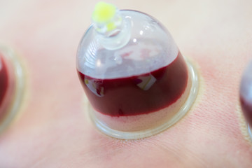 Hijama - the treatment of bloodletting. Attached vacuum cup. Blood fills in the cup.