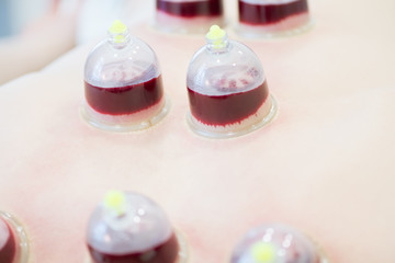Hijama - the treatment of bloodletting. Attached vacuum cup. Blood fills in the cup.