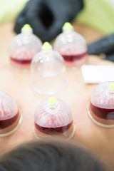Hijama - the treatment of bloodletting. Attached vacuum cup. Blood fills in the cup.
