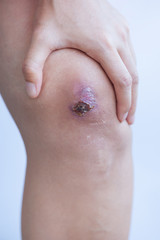 Naklejka premium Scar and scab (eschar) on asian female knee