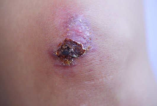 Scar and scab (eschar) on asian female knee