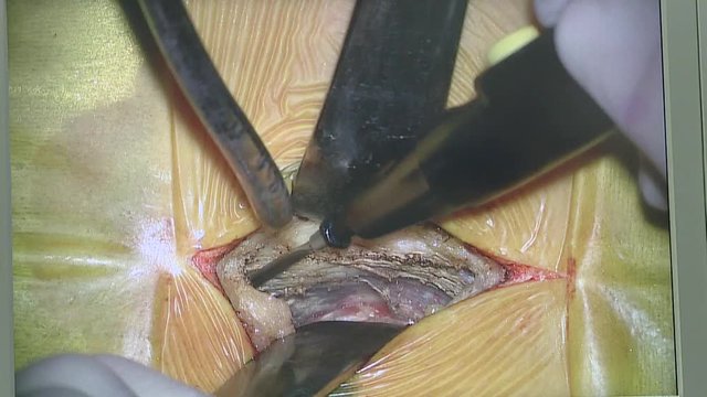 The surgeon cauterizes the blood vessels. Orthopedic surgeon team in the emergency room in sterile uniform performing surgery on a human spine, in Spine center. Modern medical background