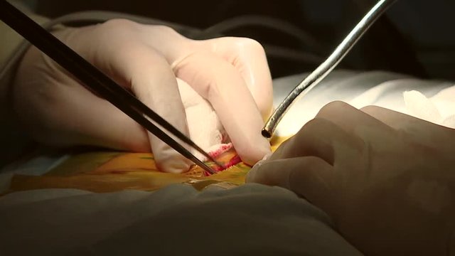 The surgeon cauterizes the blood vessels. Orthopedic surgeon team in the emergency room in sterile uniform performing surgery on a human spine, in Spine center. Modern medical background