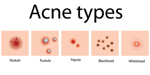 Acne types problem skin dermatology  - obrazy, fototapety, plakaty